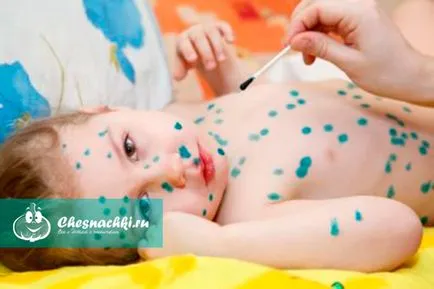 Varicela incubare perioada contagiozitate și tratată (incubare perioada contagiozitate) Perioada de incubare Varicela și infectivitatea decât vindecarea