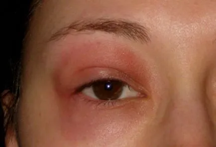 Ochiul a fost mușcată de musculițelor - umflarea și ochii umflate decât să eliminați și ce să facă în cazul în care mușcat de un copil