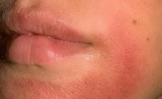 O crema de fata buna pentru pielea uscata, de ce pielea devine uscata, cum de a alege o crema pentru uscat