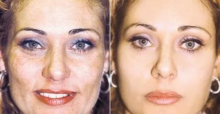 Galben se confruntă cu peeling ceea ce este, cât de des puteți face, cosmetologi comentarii și fotografii înainte și după
