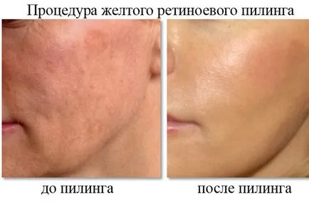 Yellow comentarii peeling fata, fotografii, rezultate înainte și după