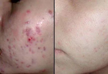 coaja galben - ceea ce este recenzii, cosmeticieni și clienții despre procedura (peeling) coaja galben - ceea ce este recenzii, cosmeticieni și clienții despre procedura