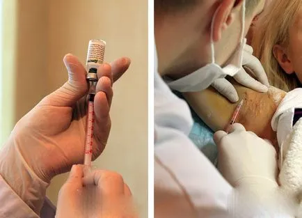 recenzii tratament hiperhidroză recenzii tratament hiperhidroză