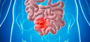 tratamentul bolii intestinului