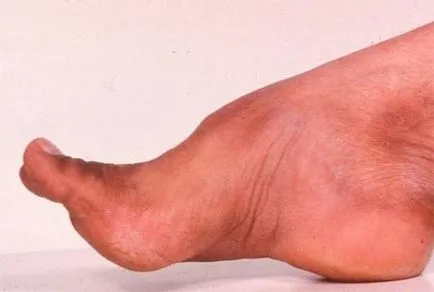Ce este cerebeloasa ataxie