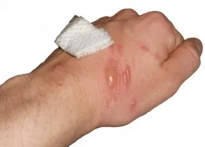 Burn Tratamentul crucea-pământului Burn Tratamentul crucea-pământului