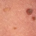 Ce se întâmplă dacă un mol bat peste Ce se întâmplă dacă un mol bat peste