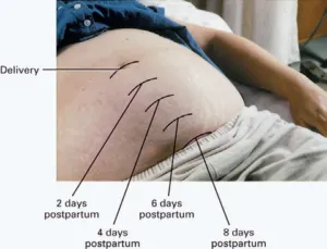 Cum să taie uterului Cum să taie uterului