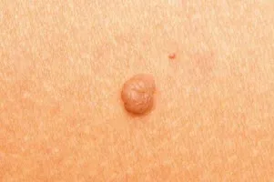 Ce se întâmplă dacă un mol bat peste