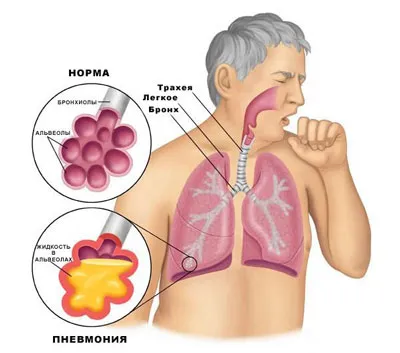 Inflamarea plămânilor care fac Inflamarea plămânilor care fac