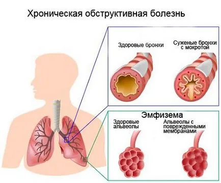 Ce este obstrucție bronșică