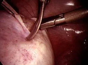 cistectomie ce cistectomie ce