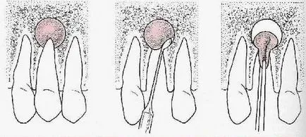 cistectomie ce