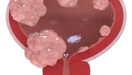 cistectomie ce