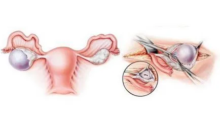 cistectomie ce