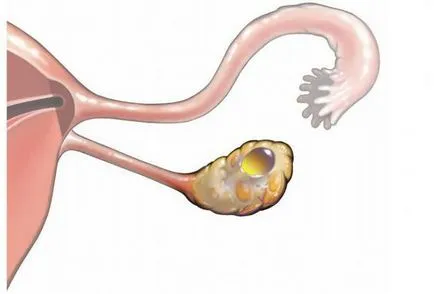 cistectomie ce