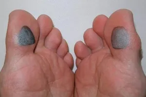 Diabetici Foot Care Diabetici Foot Care