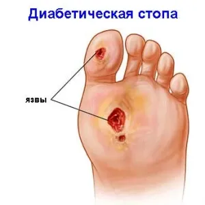 Diabetici Foot Care Diabetici Foot Care