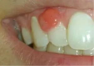 Tratamentul Flux pe gingii Tratamentul Flux pe gingii