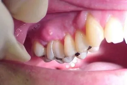 Tratamentul Flux pe gingii