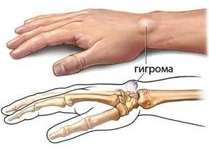 Hydroma ce este Hydroma ce este