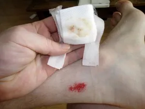 Cât de repede se vindeca rana Cât de repede se vindeca rana