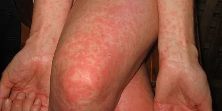Simptomele care au viermi