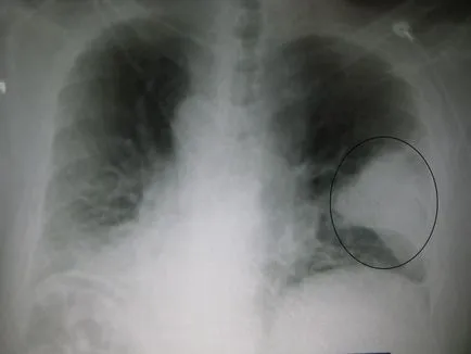 Ce este pneumonia congestiv Ce este pneumonia congestiv