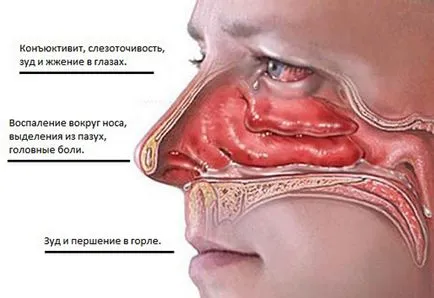 Un antibiotic pentru tratamentul sinuzitei Un antibiotic pentru tratamentul sinuzitei