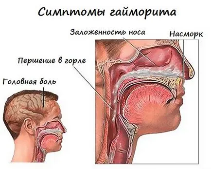 Un antibiotic pentru tratamentul sinuzitei Un antibiotic pentru tratamentul sinuzitei