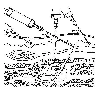 Ca preparate injectabile administrate