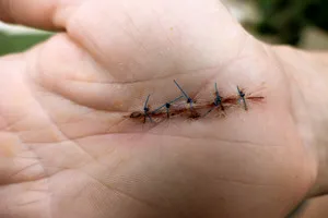 Ce se va întâmpla dacă nu trage cusături Ce se va întâmpla dacă nu trage cusături