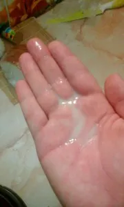 Vulvovaginal candidoza ea