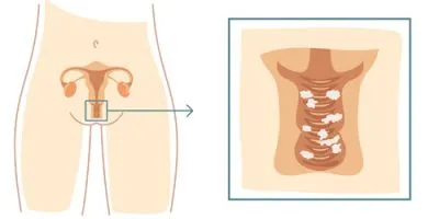 Vulvovaginal candidoza ea