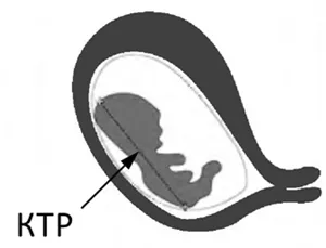 dimensiunea parietal coccisului de ea