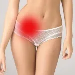 Endometrioza tratamente populare Endometrioza tratamente populare