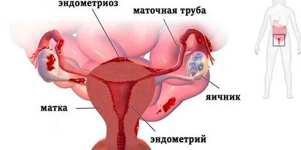 Endometrioza tratamente populare Endometrioza tratamente populare