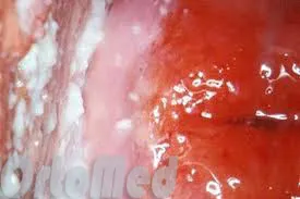 Vulvovaginal candidoza ea
