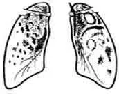 Tratamentul tuberculozei la domiciliu Tratamentul tuberculozei la domiciliu