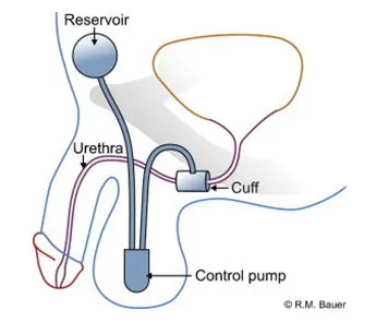 Tratamentul incontinenței urinare la barbati Tratamentul incontinenței urinare la barbati
