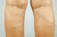 De ce am avea umflarea De ce am avea umflarea