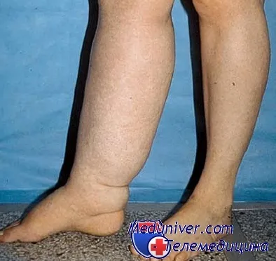 De ce am avea umflarea De ce am avea umflarea
