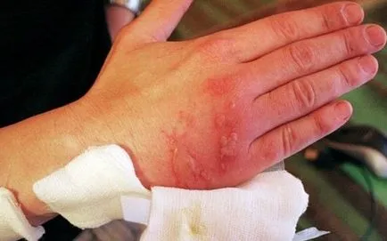 Burn Tratamentul crucea-pământului