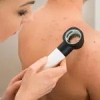 Ce ar trebui să fac în cazul în care comedon pocniți