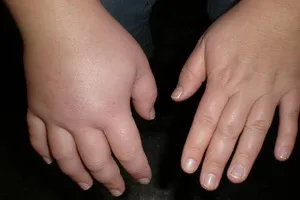 De ce am avea umflarea De ce am avea umflarea