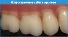 Fabricația proteze totale