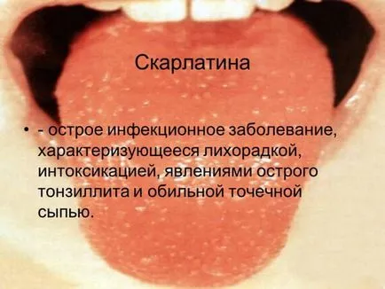 Scarlatina este acel tip de boală Scarlatina este acel tip de boală