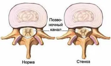 Ce este stenoza spinarii Ce este stenoza spinarii