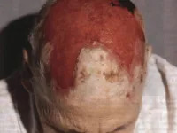 vasculare ce