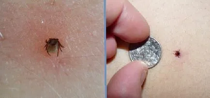 Se pare ca căpușe pe cap Se pare ca căpușe pe cap